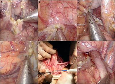 Surgical Management of Hirschsprung's Disease: A Comparative Study Between Conventional Laparoscopic Surgery, Transumbilical Single-Site Laparoscopic Surgery, and Robotic Surgery